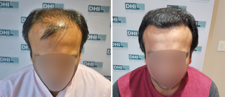 DHI before & after hair transplant results